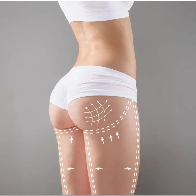 Acido Hialuronico 20Ml Gluteos, Bumbum, Cross Link- Anvisa