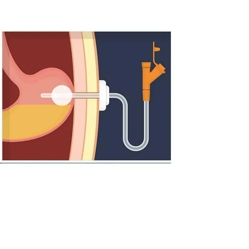 Sonda De Gastrostomia Silicone 18fr