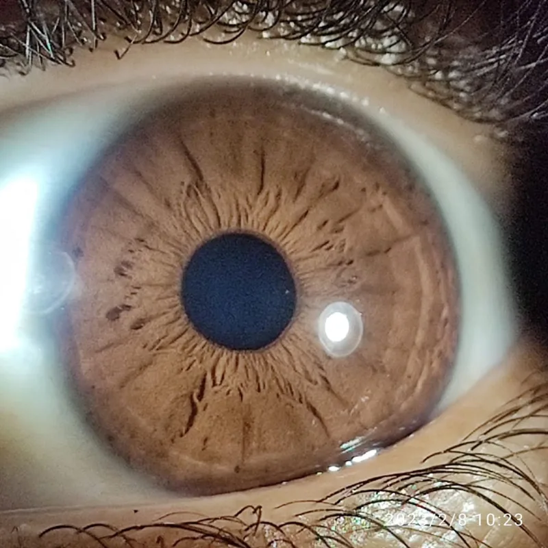 Lente Optview Para Iridologia Com Suporte Para Celular Íris Iridofoto