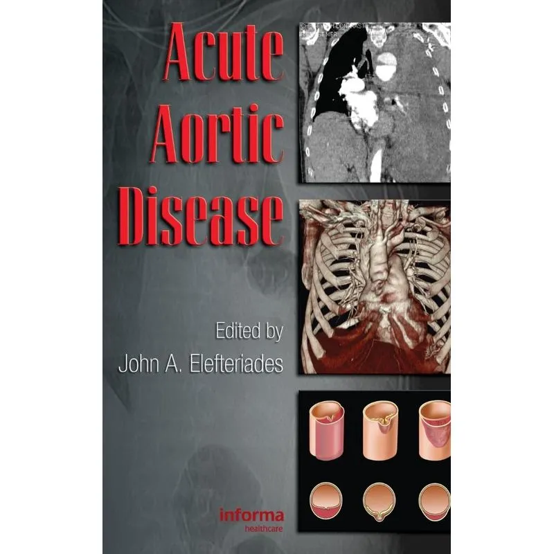 Acute Aortic Disease