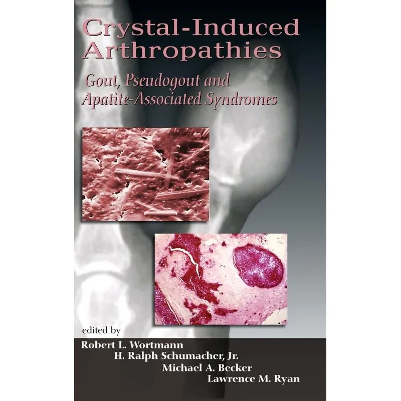 Crystal-Induced Arthropathies