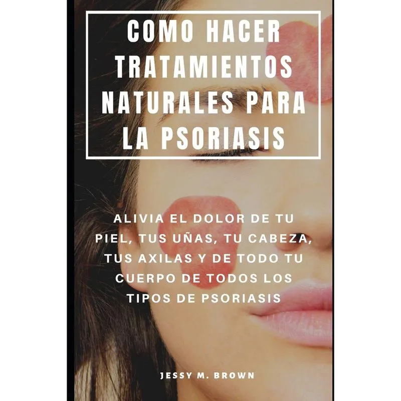 Tratamento natural da psoríase - Aliv