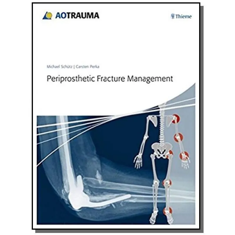 PERIPROSTHETIC FRACTURE MANAGEMENT