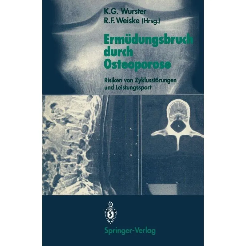 Ermüdungsbruch durch Osteoporose