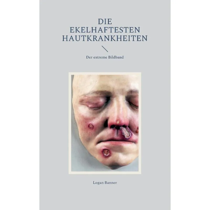 Die Ekelhaftesten Hautkrankheiten