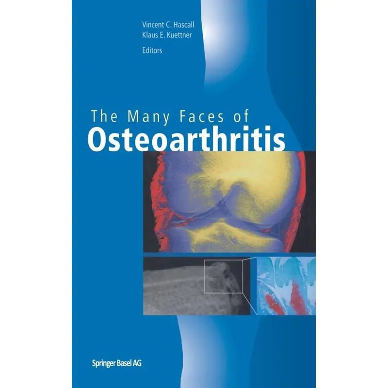 The Many Faces of Osteoarthritis