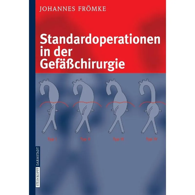 Standardoperationen In Der Gefäßchirurgie