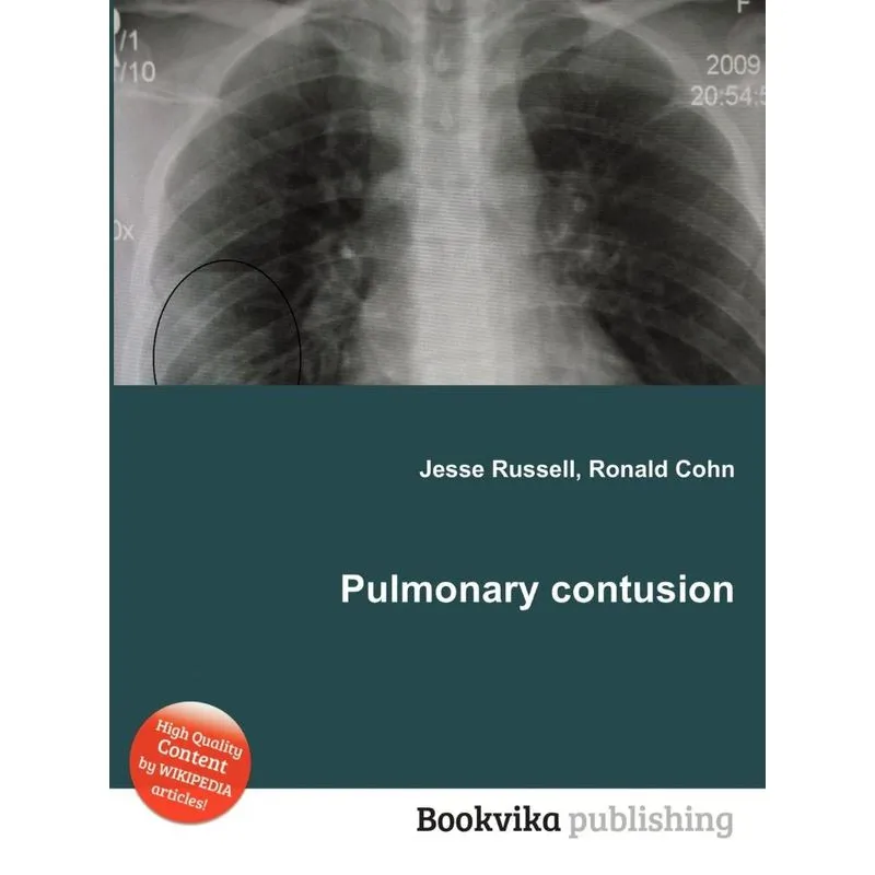 Pulmonary Contusion