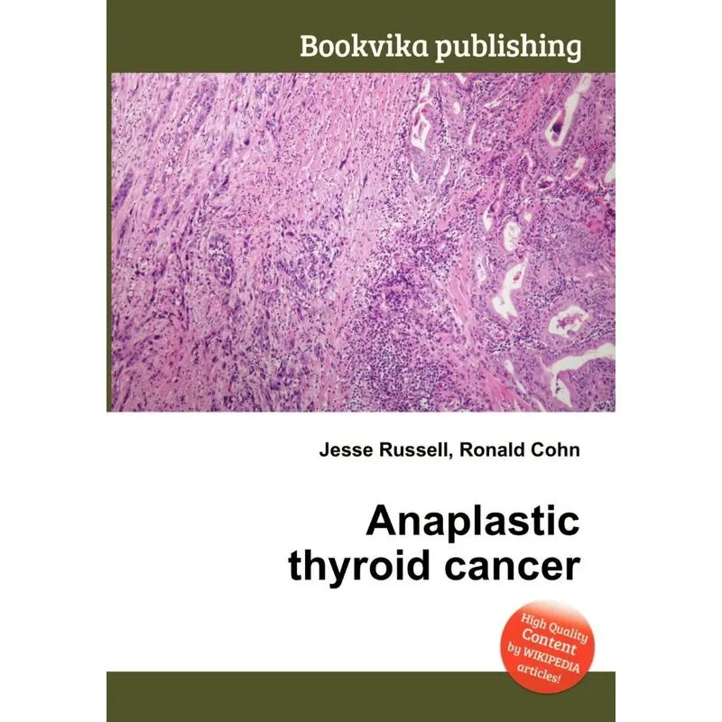 Anaplastic Thyroid Cancer