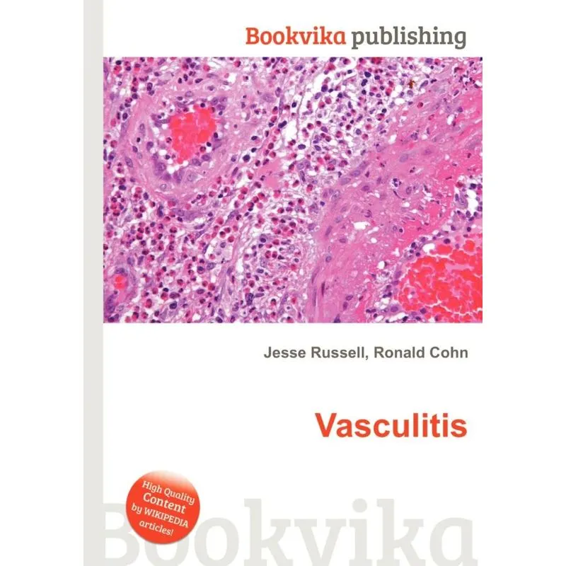 Vasculitis
