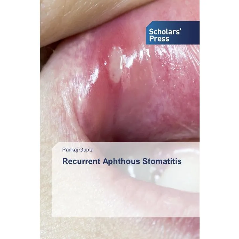 Recurrent Aphthous Stomatitis
