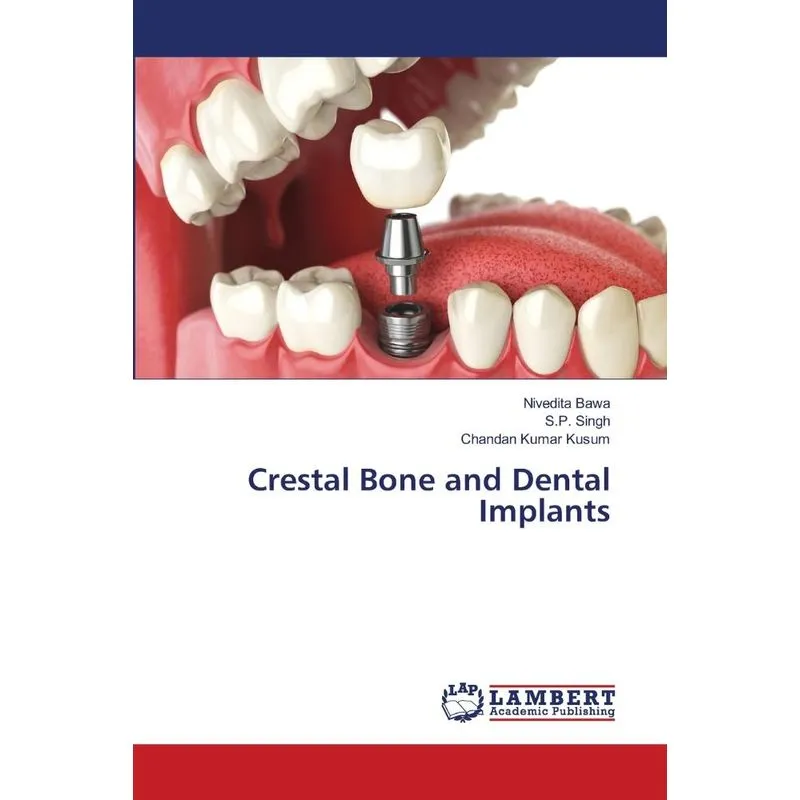 Crestal Bone and Dental Implants