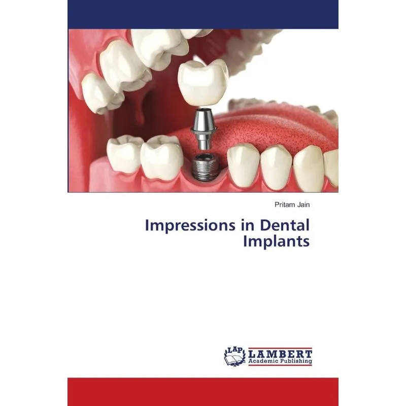 Impressions in Dental Implants