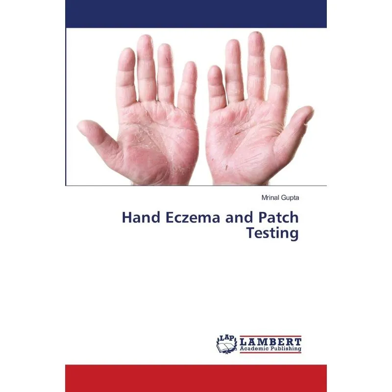 Hand Eczema and Patch Testing