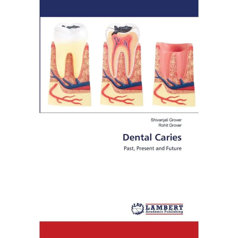 Dental Caries