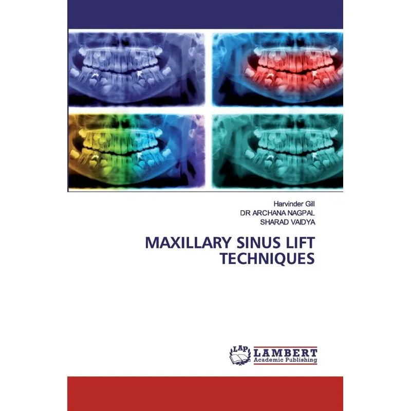 MAXILLARY SINUS LIFT TECHNIQUES