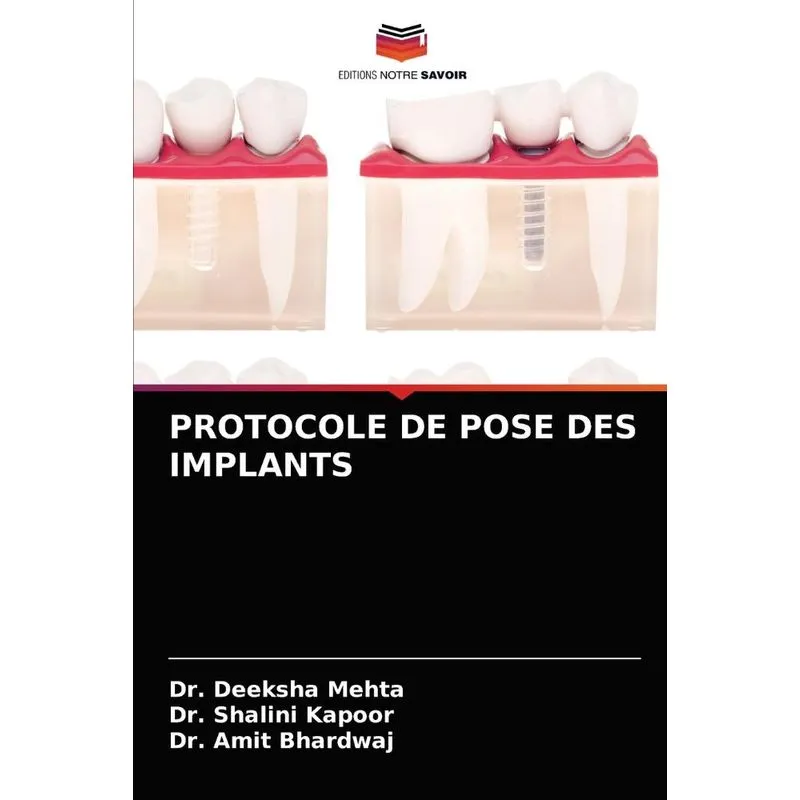 PROTOCOLE DE POSE DES IMPLANTS