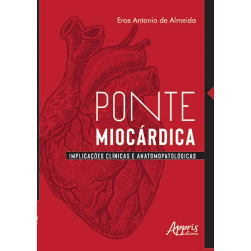 PONTE MIOCÁRDICA