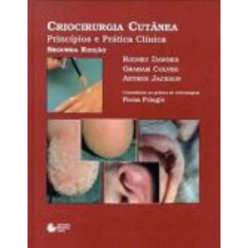 Criocirurgia cutânea