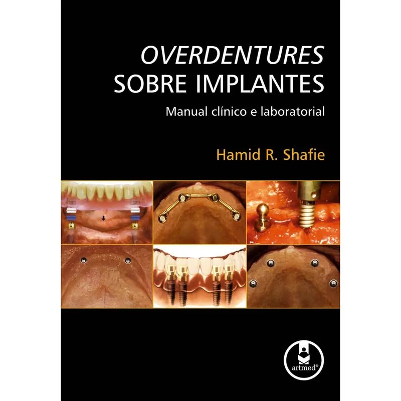 Livro - Overdentures Sobre Implantes: Manual Clínico e Laboratorial