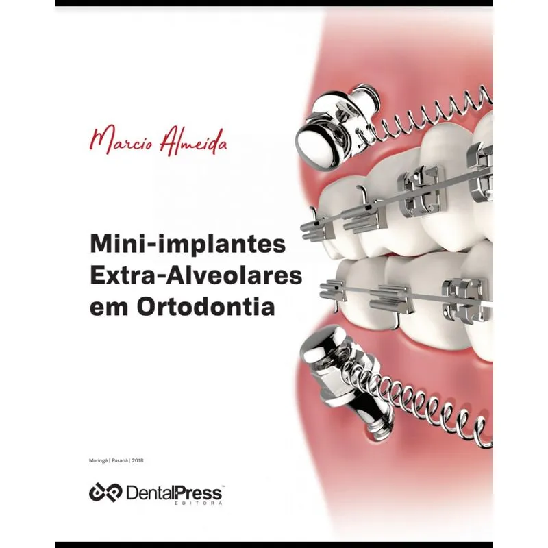 Mini-Implantes Extra-Alveolares Em Ortodontia