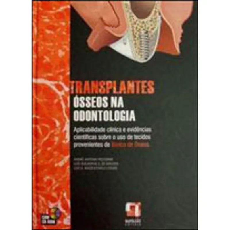 TRANSPLANTES OSSEOS NA ODONTOLOGIA