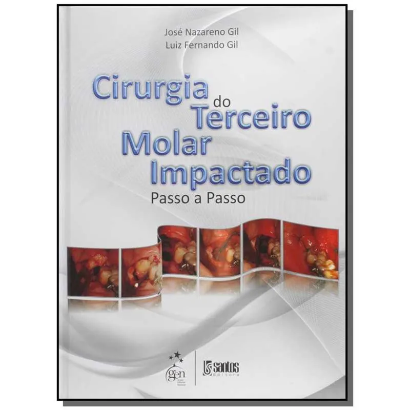 Cirurgia Do Terceiro Molar Impacto - Passo A Passo